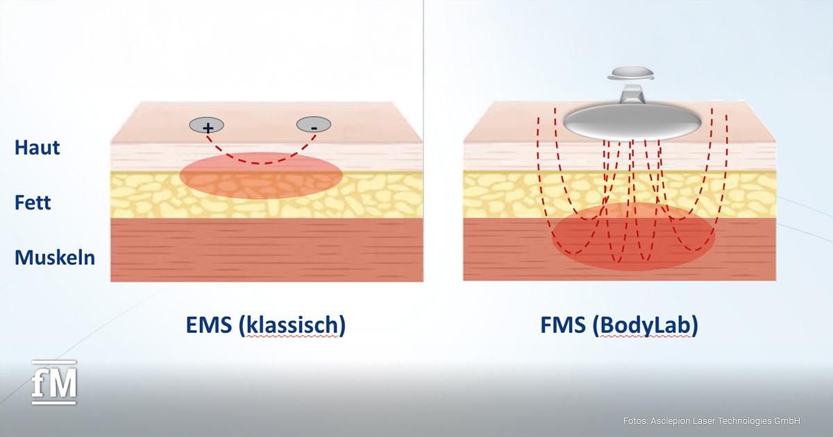 Zwei Querschnittgrafiken zeigen Haut, Fett und Muskeln. Links: klassische EMS mit flacher Wirkung. Rechts: FMS von BodyLab mit tiefer, gezielter Stimulation. Unterschiedliche Techniken zur Muskelaktivierung werden verglichen
